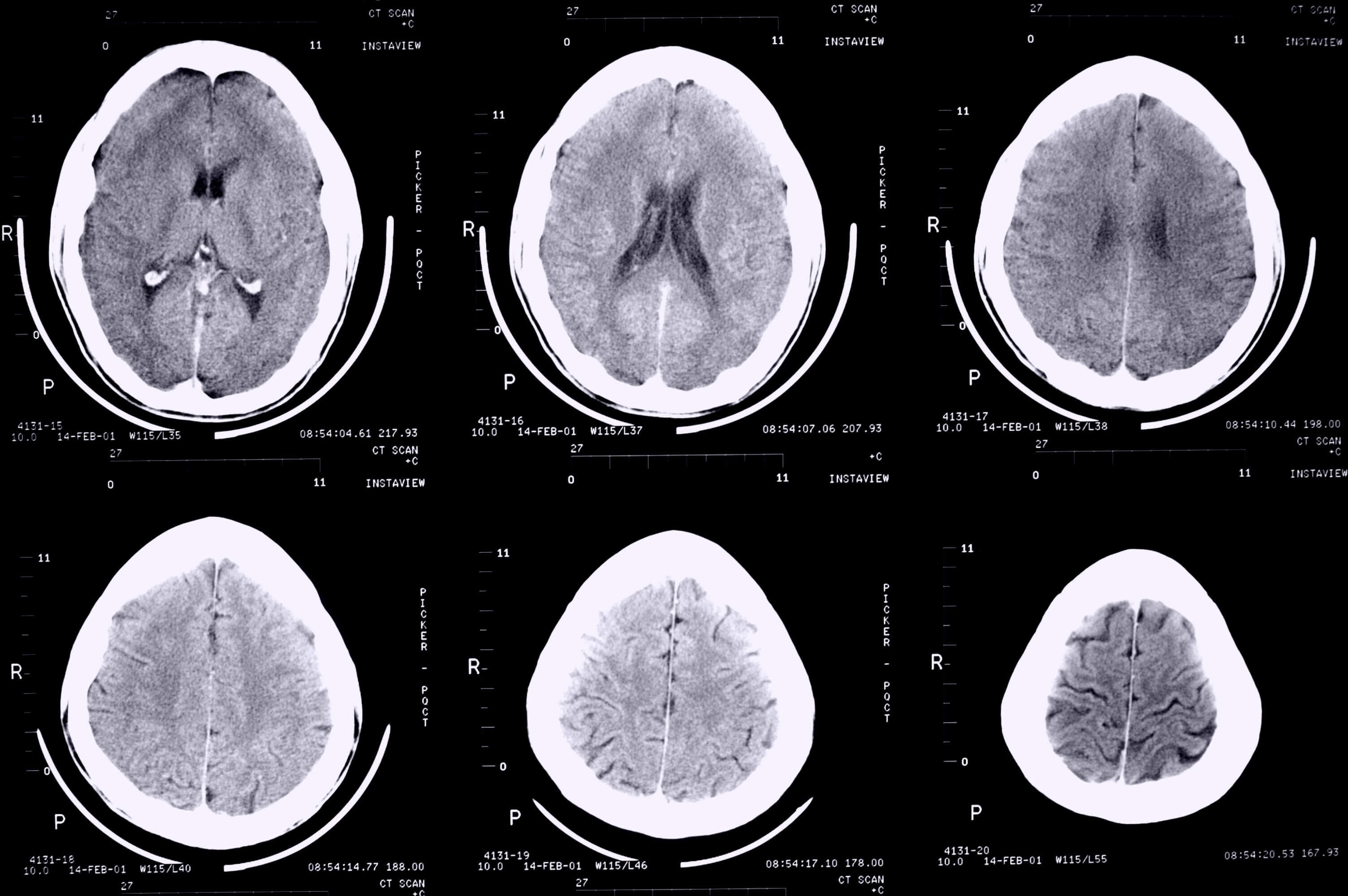 Epilepsy brain scans